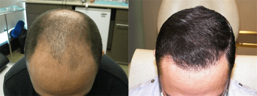 A man hair transplant before and after.
